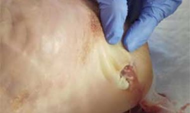 Remédio do Iepa (Amapá) cura o pé diabético e no RJ é a principal causa de amputação